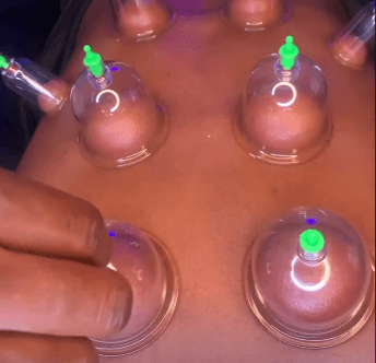 Cupping Therapy